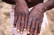 Sudan records first confirmed case of monkeypox