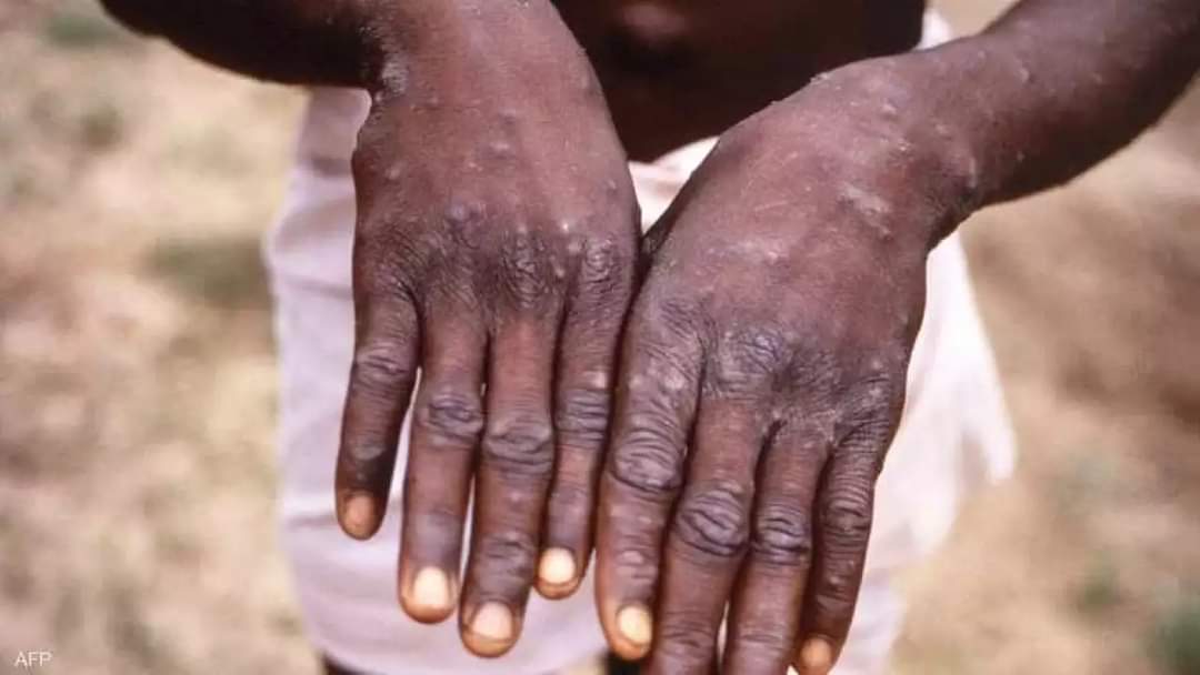 Sudan records first confirmed case of monkeypox